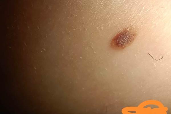 手腕痣相探秘：一痣解千愁，揭秘运势密码