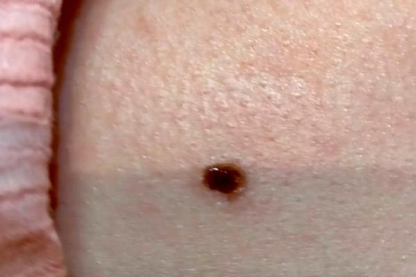 背后痣：男人魅力加分项？